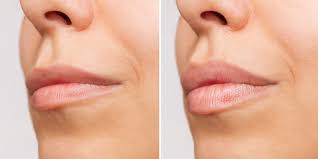 Luscious Lips Await: Hoboken’s Lip Filler Solutions post thumbnail image